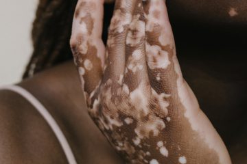 DIA MUNDIAL DO VITILIGO: ENTENDA OS SINTOMAS, IMPACTO E TRATAMENTO DA DOENÇA QUE ATINGE MAIS DE UM MILHÃO DE BRASILEIROS