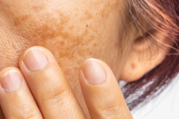 MELASMA NO VERÃO: CUIDADOS ESSENCIAIS APÓS A EXPOSIÇÃO SOLAR