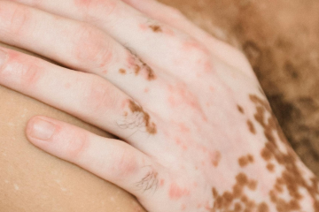 Dia Mundial do Vitiligo: quais os sintomas da doença que afeta mais de 1 milhão de brasileiros
