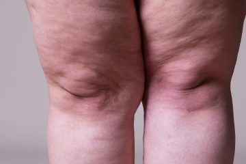 Ribeirão Preto oficializa Mês de Conscientização sobre o Lipedema