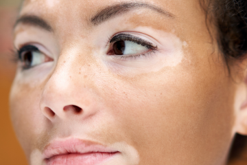 Dia Mundial do Vitiligo: doença pode surgir antes dos 30 anos e exige atenção aos primeiros sinais